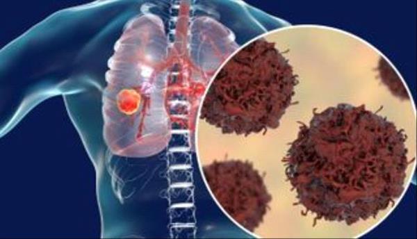 داوني بالتي كانت هي الداء.. علاج الأورام بخلايا سرطانية مبردة