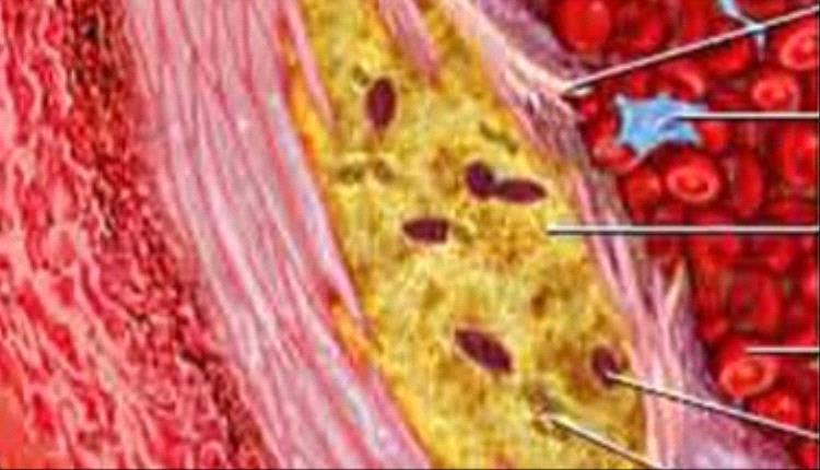 الكوليسترول مش مضر.. 7 خرافات عنه لا تصدقها
